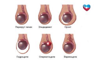 Одно яичко ниже другого у мужчин: почему и что делать?