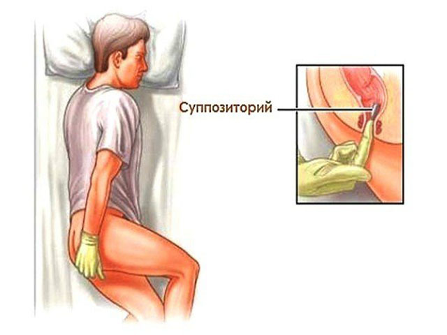 Индометацин (свечи и таблетки) при простатите: лечение и отзывы