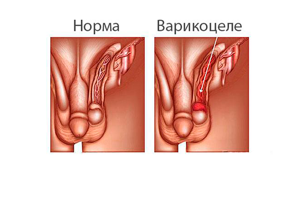 Олигоспермия у мужчин: степени, причины, лечение