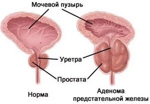 Голодание при простатите и аденоме простаты: лечение и отзывы
