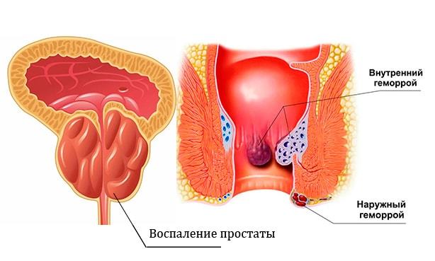 Влияет ли геморрой на потенцию у мужчин и как?