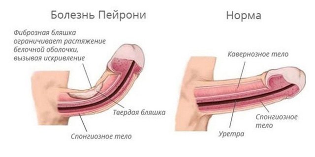 Кривой член (на фото): правда и мифы, почему секс с таким у мужчин нравится девушкам, что делать