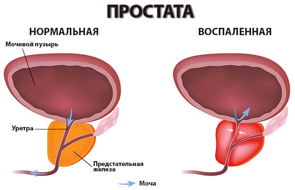 Бактериальный простатит у мужчин: причины, симптомы и лечение