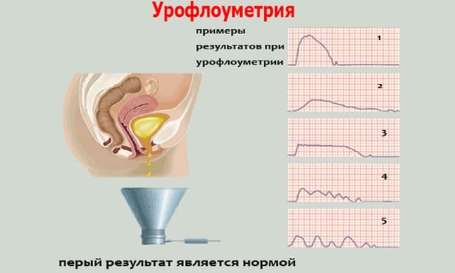 Урофлоуметрия: что это такое, как проводится, подготовка к процедуре, цена