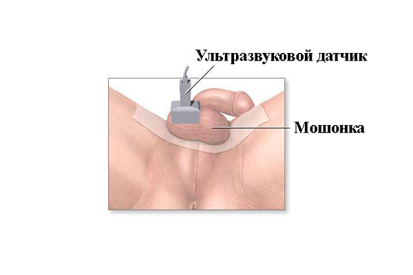 Олигоспермия у мужчин: степени, причины, лечение