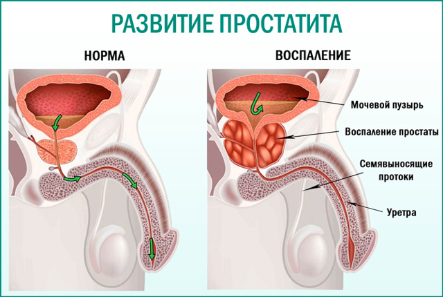 Трихопол при простатите: инструкция по применению, лечение мужчин, отзывы