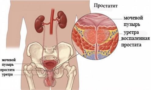 Простаторея: 100% про болезнь у мужчин, причины, симптомы, лечение