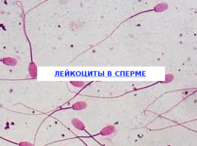 Лейкоцитоспермия у мужчин: причины, симптомы, лечение