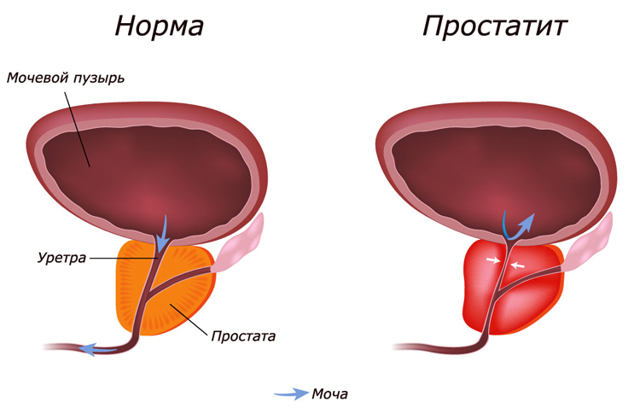 Простатит у ребенка и подростка: может ли быть, симптомы и лечение