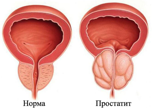 Пиво при простатите и аденоме простаты: можно ли пить?