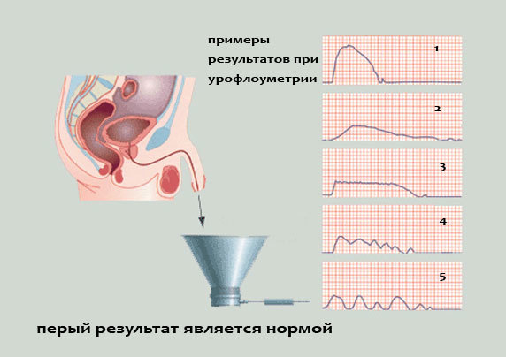 Урофлоуметрия: что это такое, как проводится, подготовка к процедуре, цена