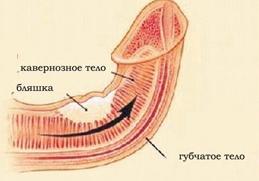 Болезнь Пейрони: причины и лечение, симптомы (фото у мужчин)