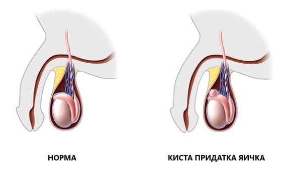 Сперматоцеле у мужчин: причины, симптомы, лечение