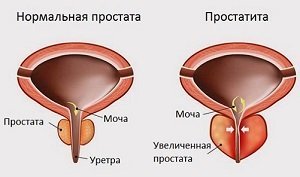 Голодание при простатите и аденоме простаты: лечение и отзывы