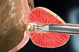 Ретроградная эякуляция у мужчин: причины и лечение, профилактика