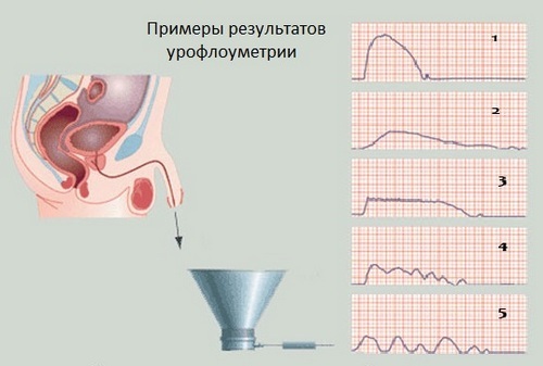 Урофлоуметрия: что это такое, как проводится, подготовка к процедуре, цена