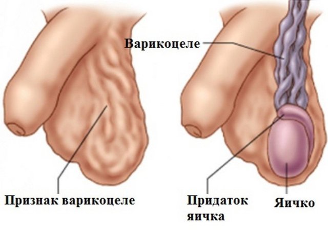 Опухли яички и болят у мужчины: причины, почему отекает мошонка, как лечить