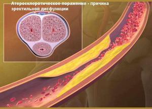 Слабая эректильная функция у мужчин: причины и лечение