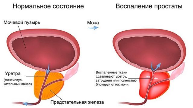 Гнойный простатит у мужчин: причины, признаки и симптомы, лечение, профилактика