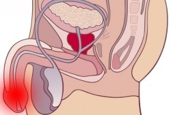 enterococcus faecalis у мужчин: норма, причины, симптомы и лечение