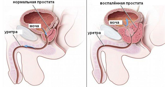 Простатит и потенция мужчин: влияние и лечение импотенции