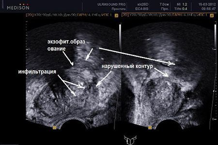 Простаторея: 100% про болезнь у мужчин, причины, симптомы, лечение