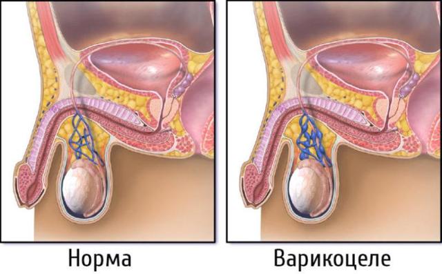Влияет ли варикоцеле на потенцию мужчины и как?