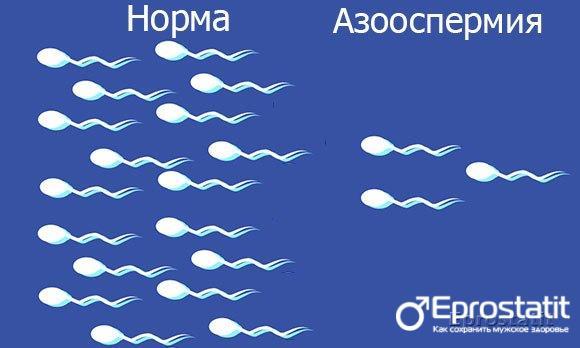 Жидкая прозрачная сперма: 12 причин, почему такой стала, что делать мужчине