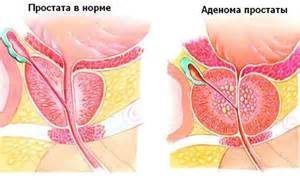 Иван-чай при простатите и аденоме простаты: как заваривать и пить, лечение, отзывы мужчин