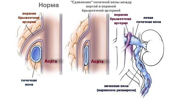 Влияет ли варикоцеле на потенцию мужчины и как?