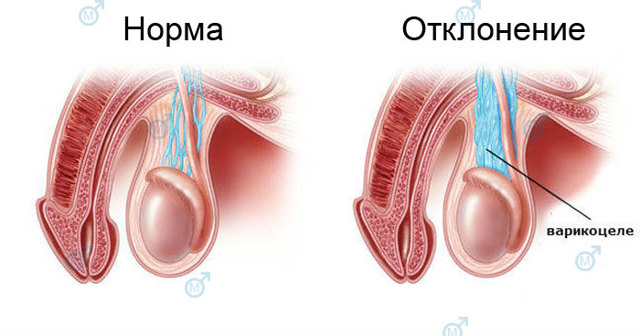 Влияет ли варикоцеле на потенцию мужчины и как?