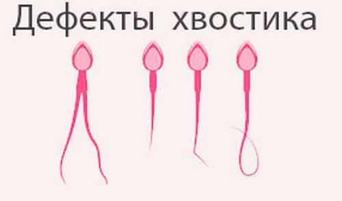 Астеноспермия у мужчин: причины, симптомы, лечение