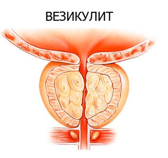 Везикулит у мужчин: симптомы и лечение хронической и острой формы