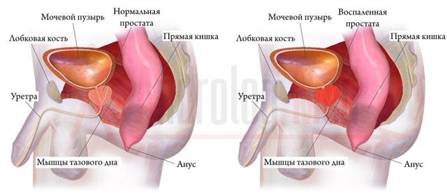 Кровь в сперме у мужчин: причины и лечение, что это означает?