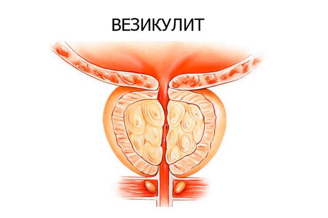 Жжение и зуд при простатите у мужчин: почему и как убрать?