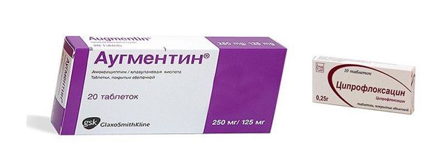 Калькулезный хронический простатит (камни в простате): симптомы и лечение, отзывы