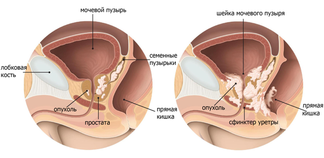 Жжение и зуд при простатите у мужчин: почему и как убрать?