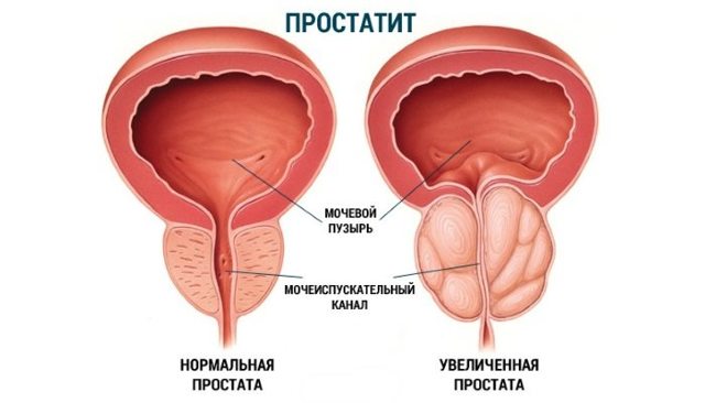 Низкий уровень тестостерона у мужчин: причины, признаки, лечение