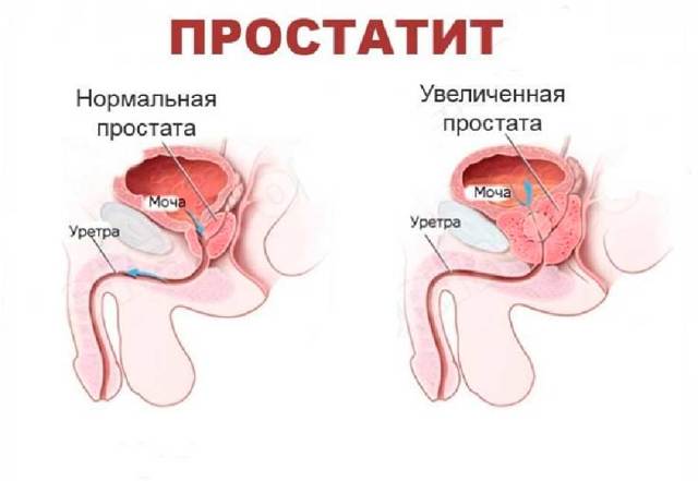 Запущенный простатит у мужчин: причины, симптомы и признаки, лечение