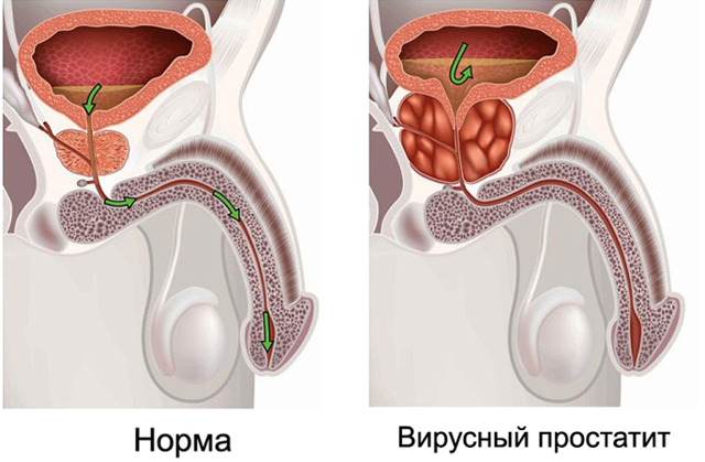Вирусный простатит у мужчин: лечение, причины и симптомы, профилактика