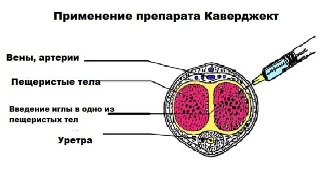 Каверджект: инструкция по применению, цена в аптеке, отзывы мужчин